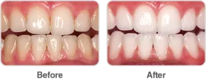 25585 opalescence boost teeth whitening before after