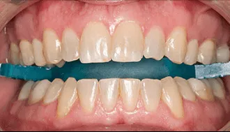 25585 opalescence boost teeth whitening process