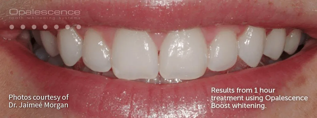 /img/25585-opalescence-boost-teeth-whitening-results.webp