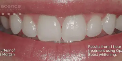 /img/25585-opalescence-boost-teeth-whitening-results.webp