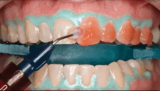 25585 opalescence boost teeth whitening smile