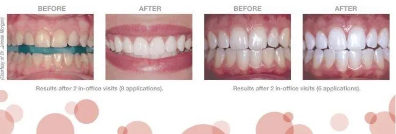 25585 opalescence boost teeth whitening treatment