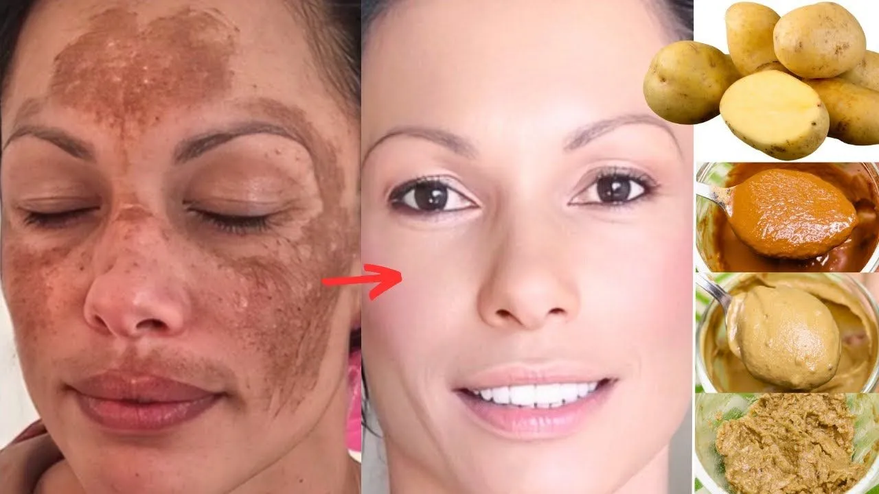 25589 skin before and after potato mask