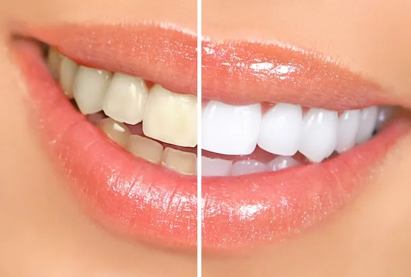25590 teeth whitening sensitivity causes