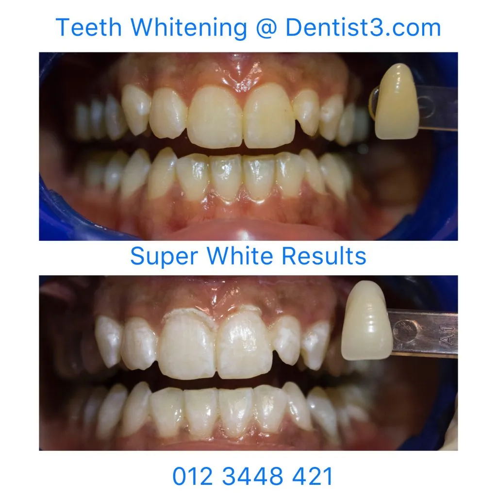 25591 cosmetic dentist whitening intro