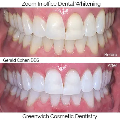 25591 take home whitening