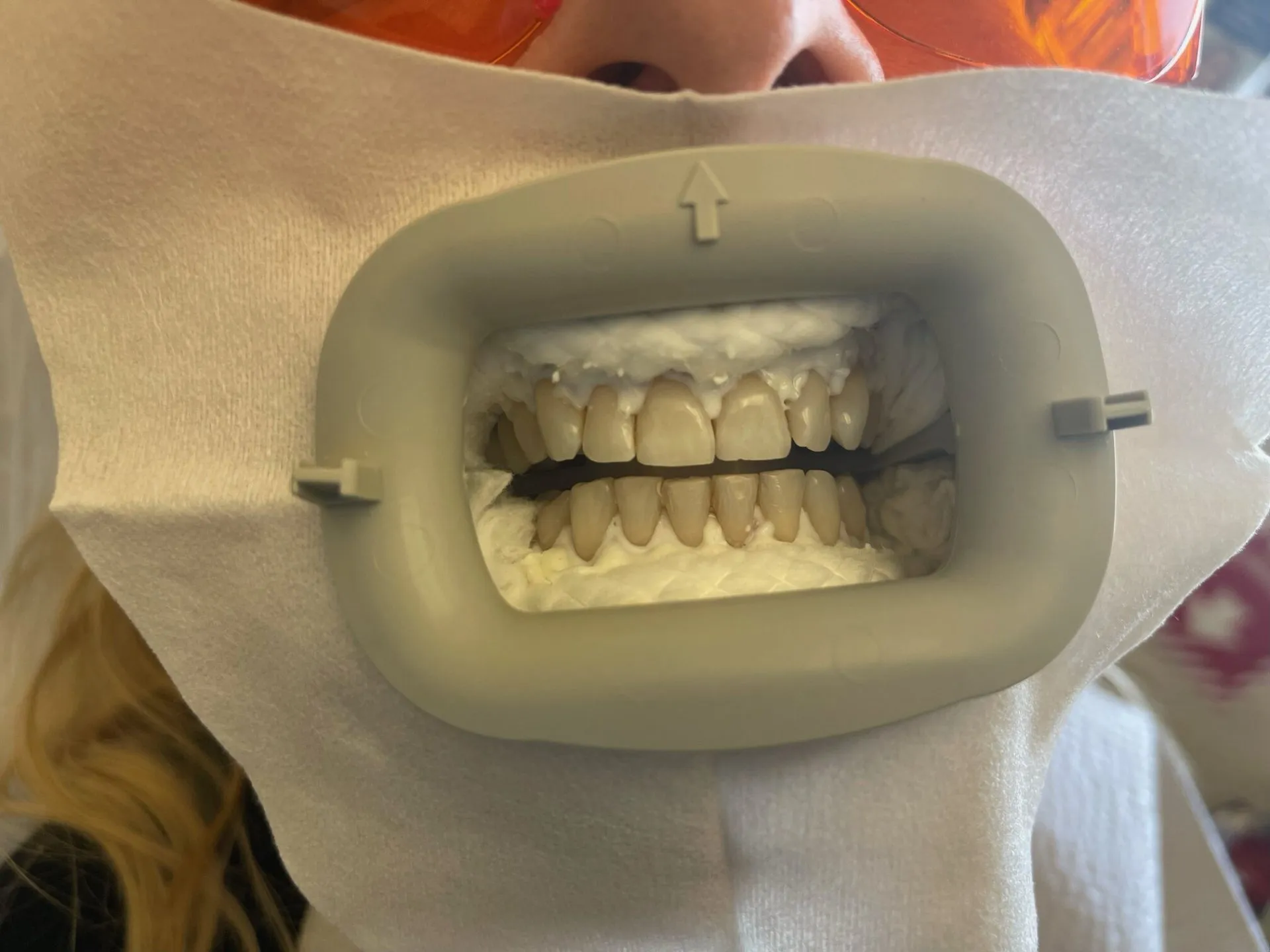 25591 teeth cleaning