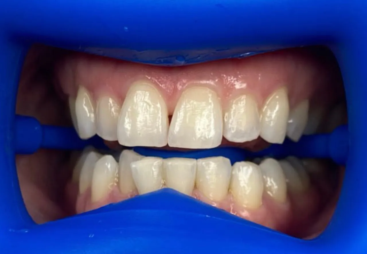 25595 professional teeth whitening