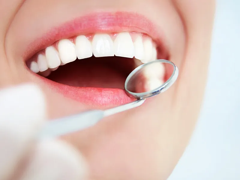 25605 at home teeth whitening kit