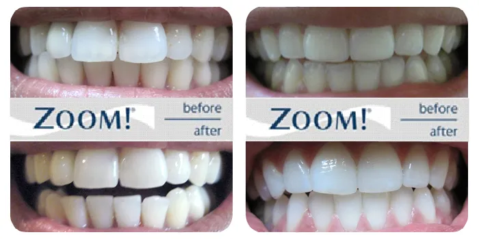 25613 zoom teeth whitening long lasting