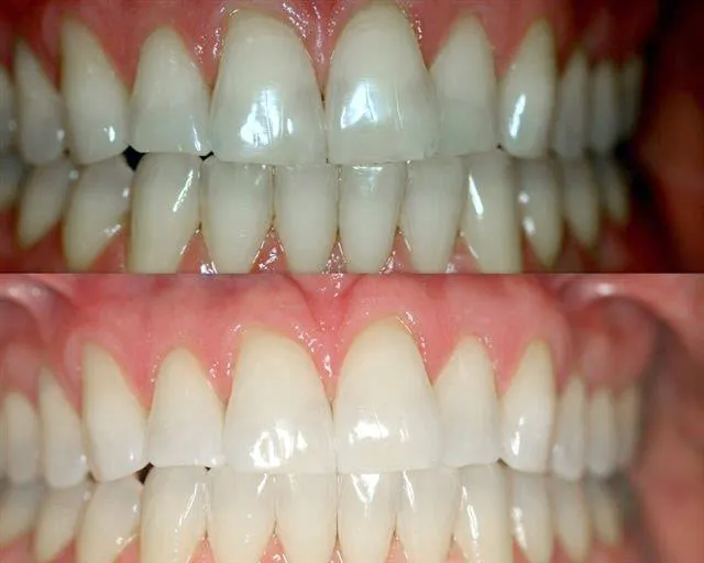 25613 zoom teeth whitening professional