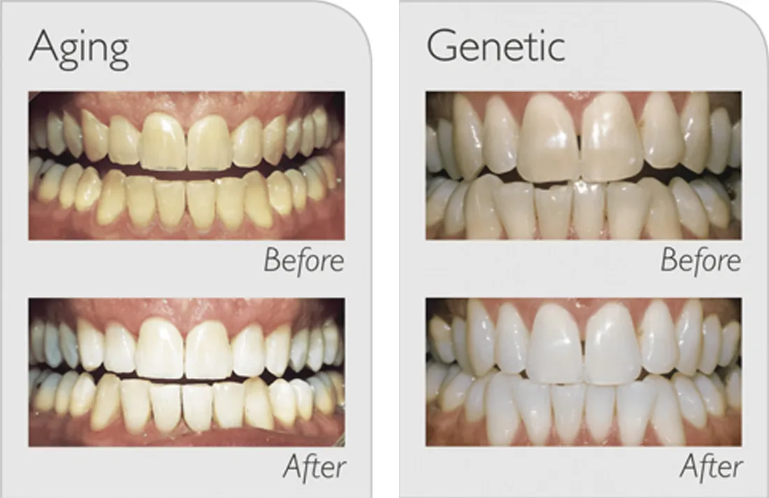 25613 zoom teeth whitening results