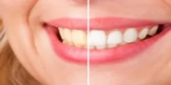 25620 teeth whitening whitby 1