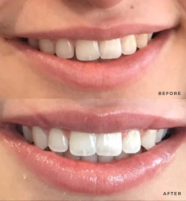 25622 teeth whitening charlotte confidence