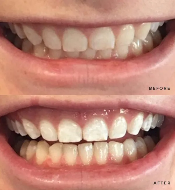 25622 teeth whitening charlotte oral health