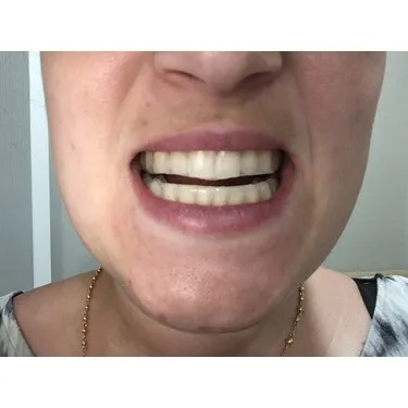 25629 whitening strips application